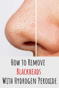 How To Remove Blackheads with Hydrogen Peroxide